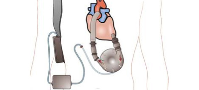 浅谈心力衰竭治疗手段的未来 浅谈心力衰竭治疗手段的未来