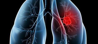 微创手术，女性早期肺癌治疗的“幸运之选”